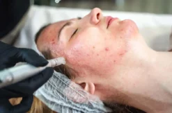 Microneedling Ingolstadt